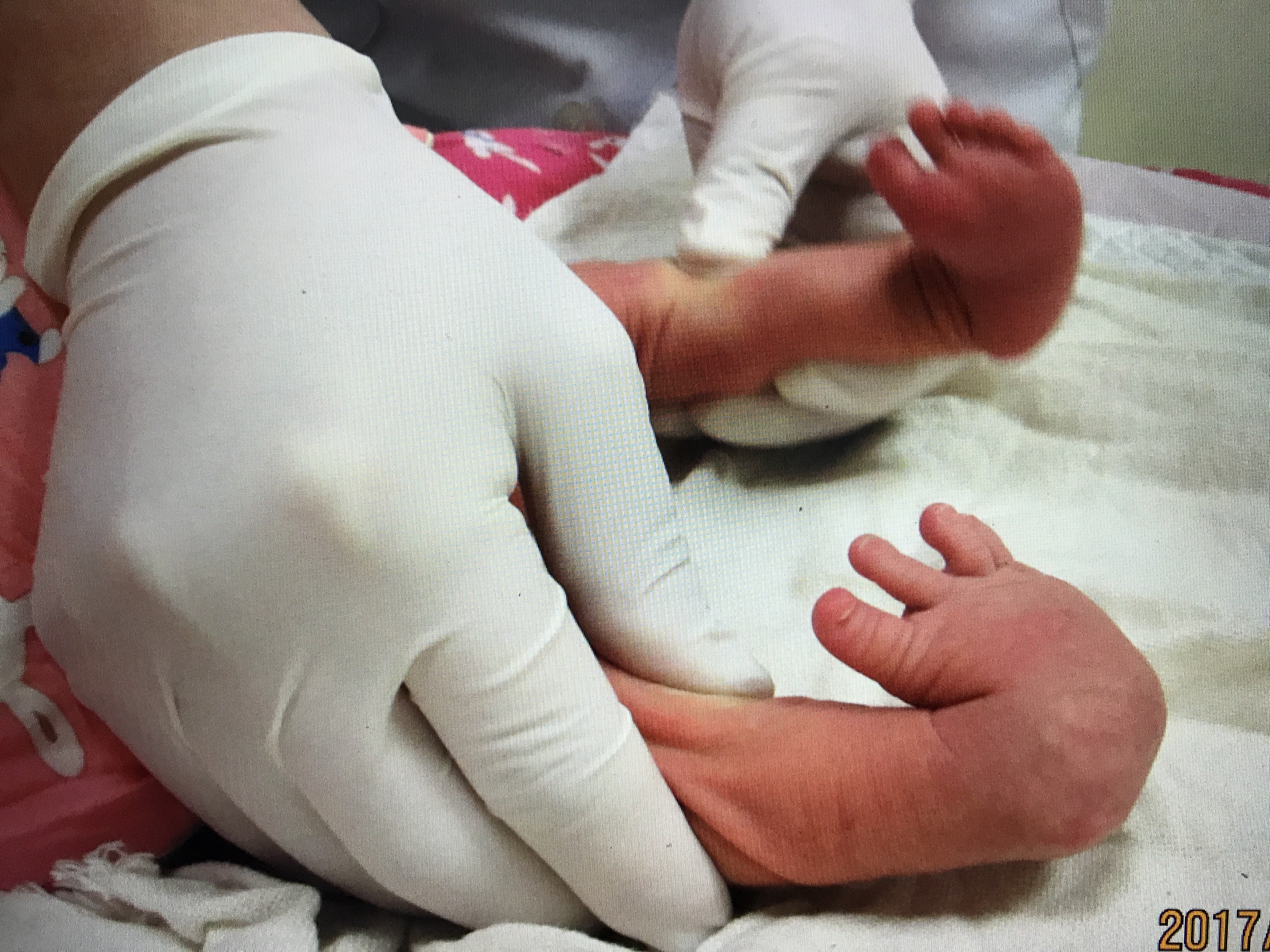 新生儿先天性马蹄内翻足ponseti方法结合软石膏治疗
