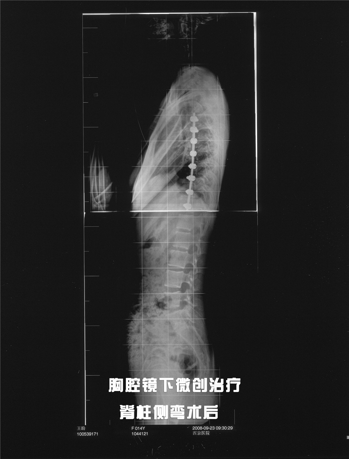 案例陶惠人教授脊柱侧弯经胸腔镜下微创手术案例四