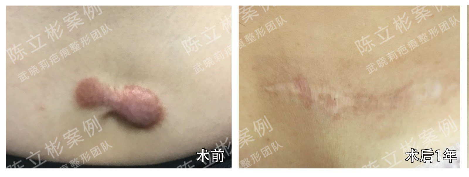 乳房全切术后疤痕图片图片
