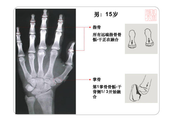 骨龄图谱身高测试