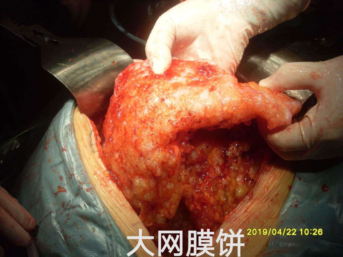 病例48--女性高腹压pmp导致呼吸困难 - 好大夫在线