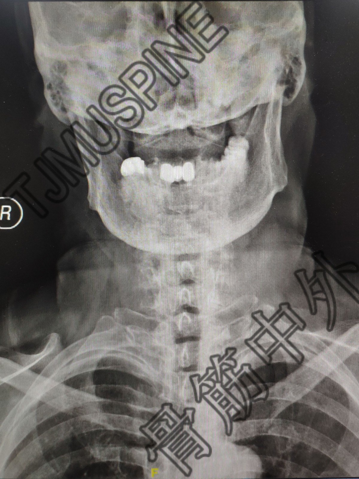 颈椎后路单开门减压术