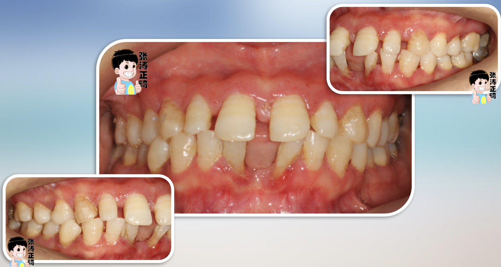 牙列稀疏 - 好大夫在线