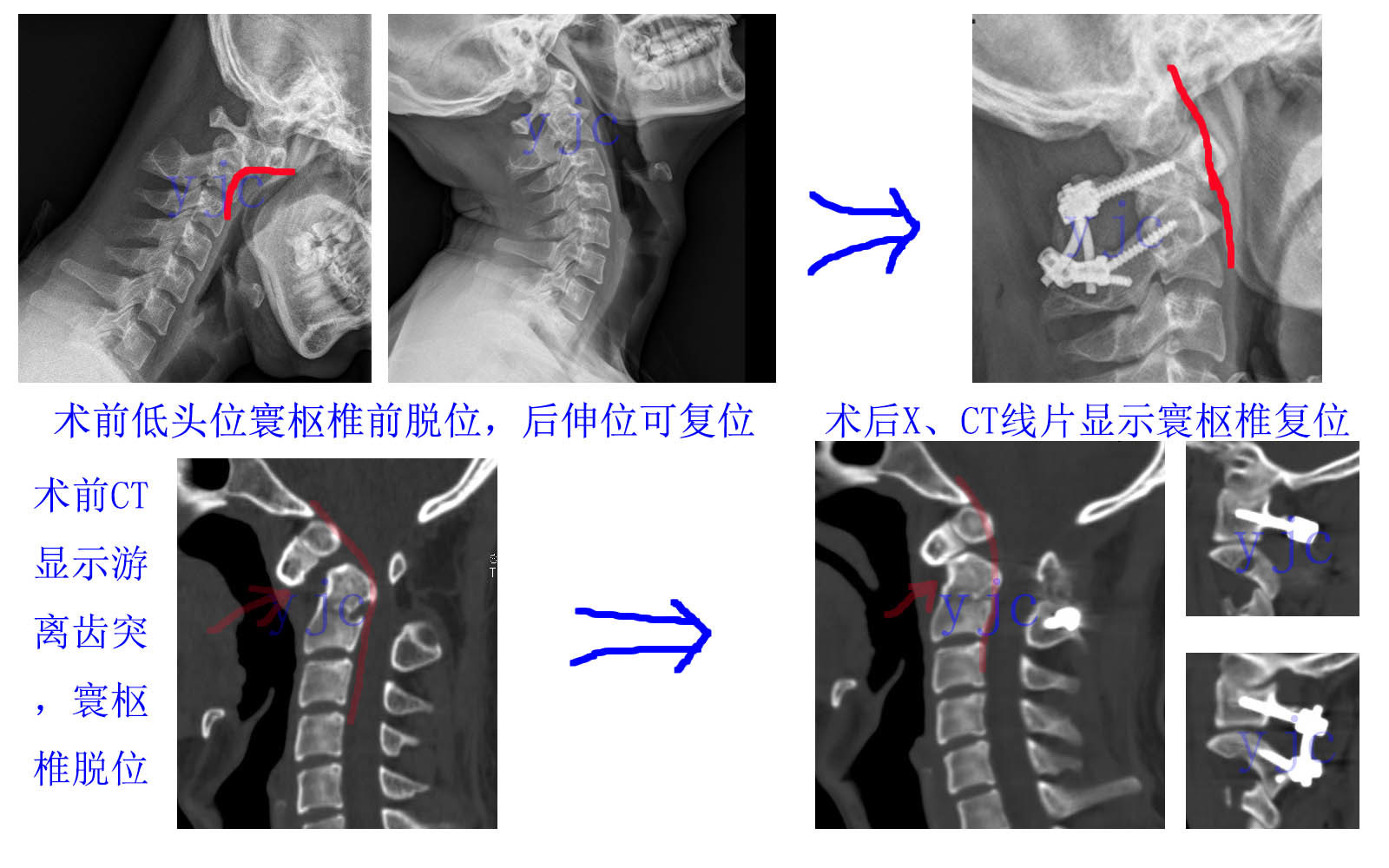 可復型寰樞椎脫位後路手術解剖復位治癒