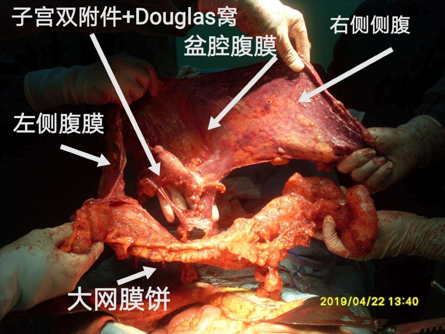 病例48--女性高腹压pmp导致呼吸困难 - 好大夫在线