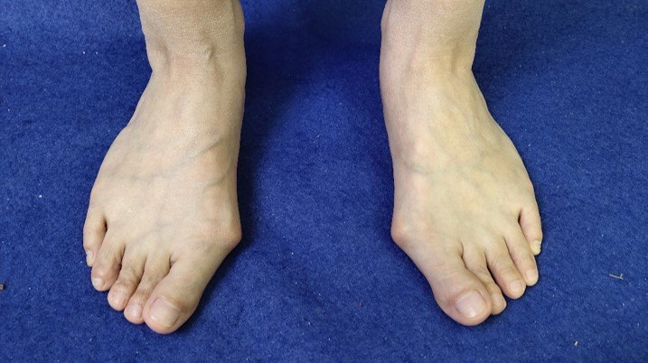 拇趾正常外翻角度是0-15度,外翻超过15度,属于拇外翻.