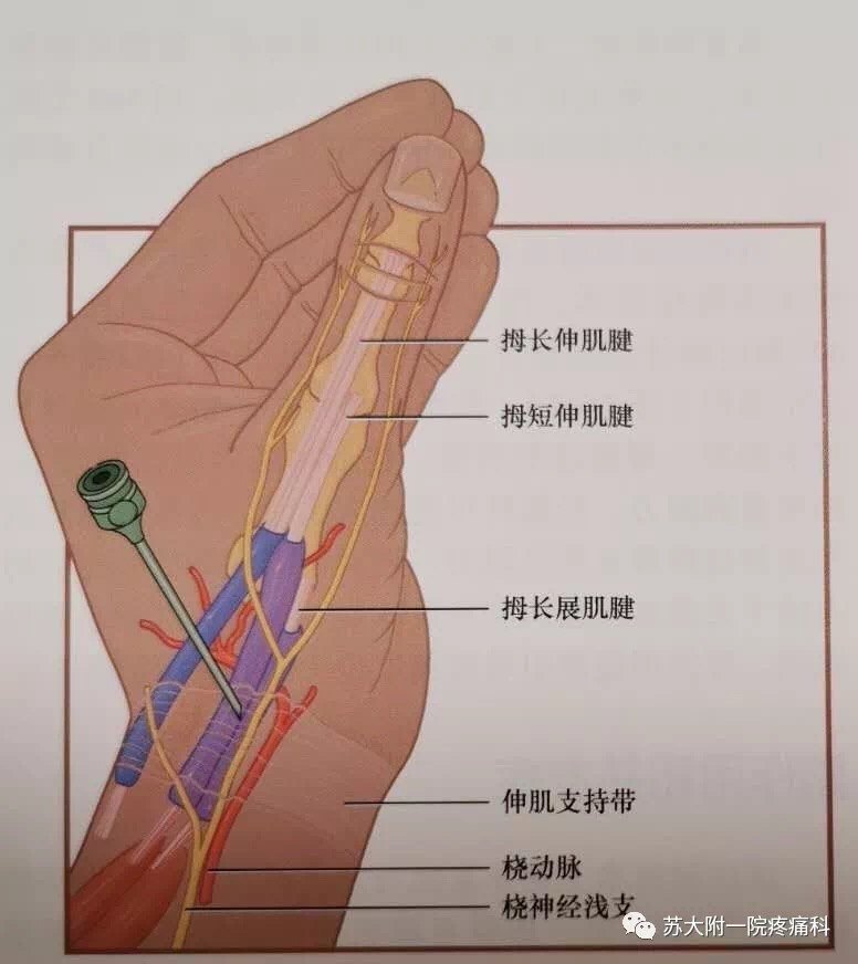 拇指腱鞘解剖图图片