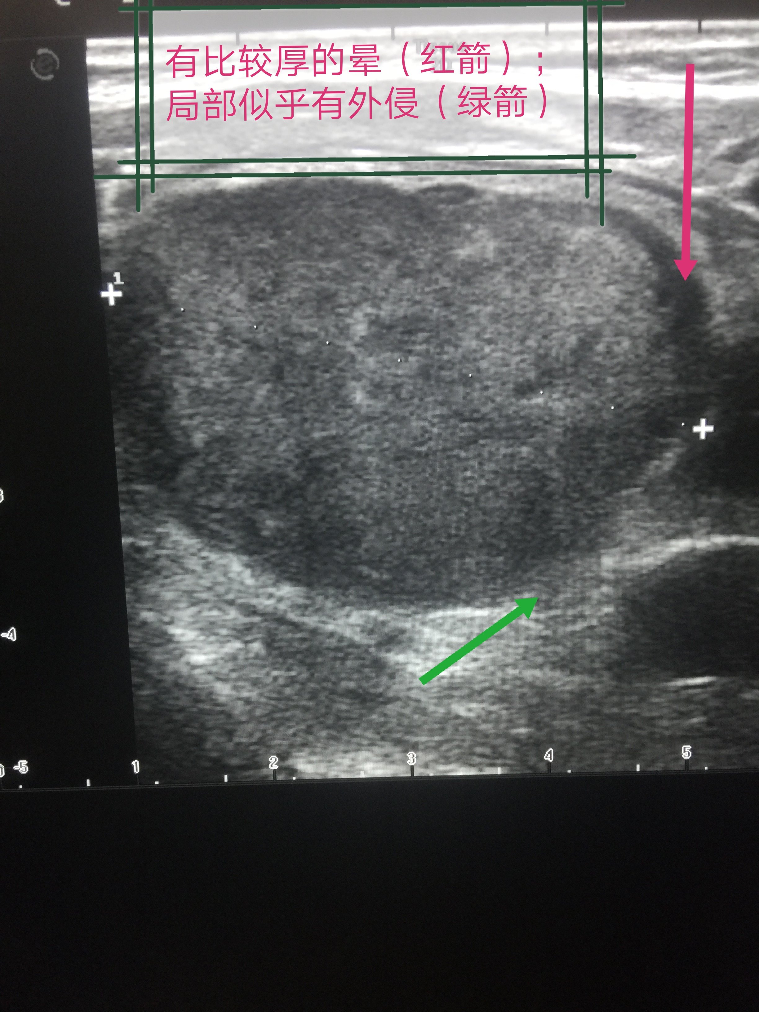 甲状腺髓样癌超声诊断 - 好大夫在线