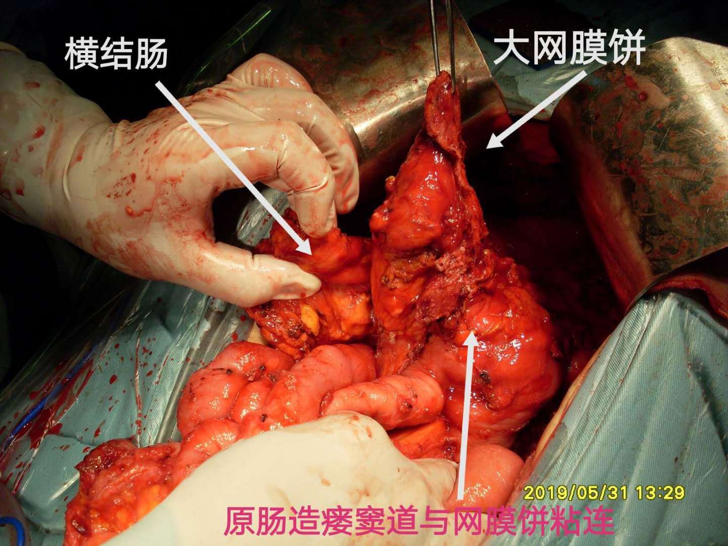 病例70--以阑尾脓肿发现pmp反复手术治疗 - 好大夫在线