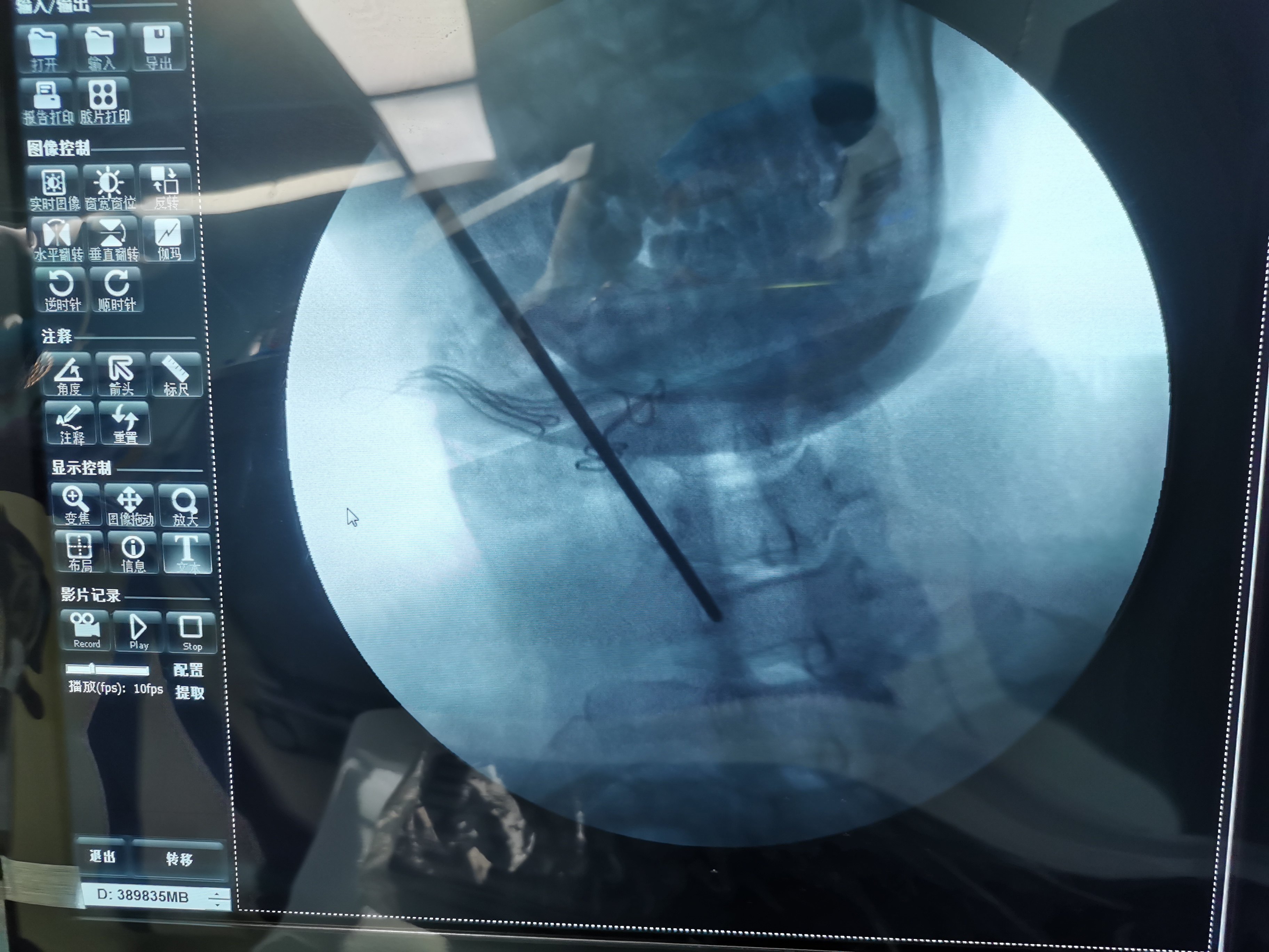 颈椎间孔镜 - 好大夫在线