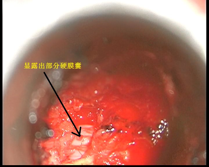 部分黄韧带切除开窗后显露硬膜囊.BMP
