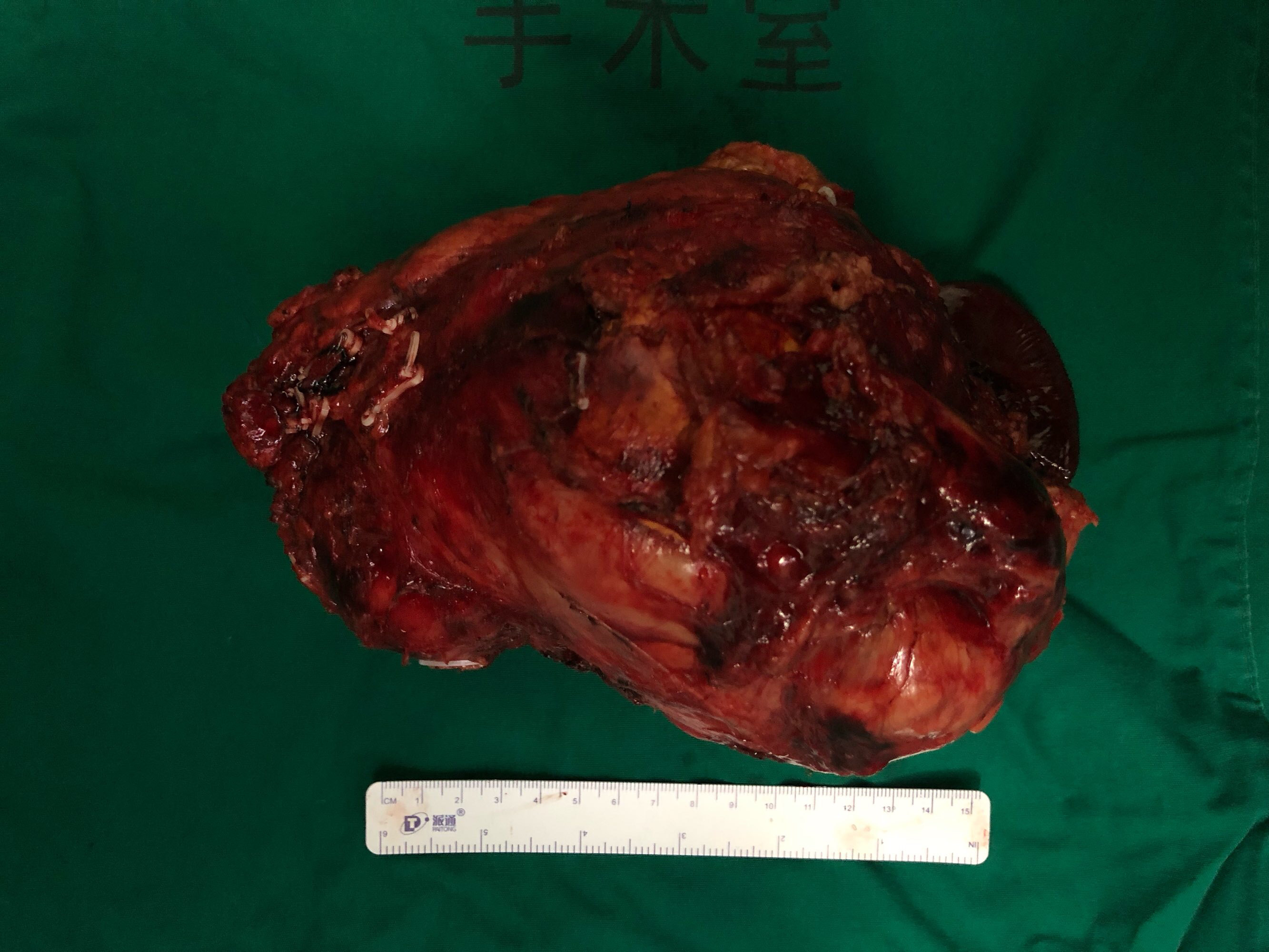 腹膜后肿瘤平滑肌肉瘤图片
