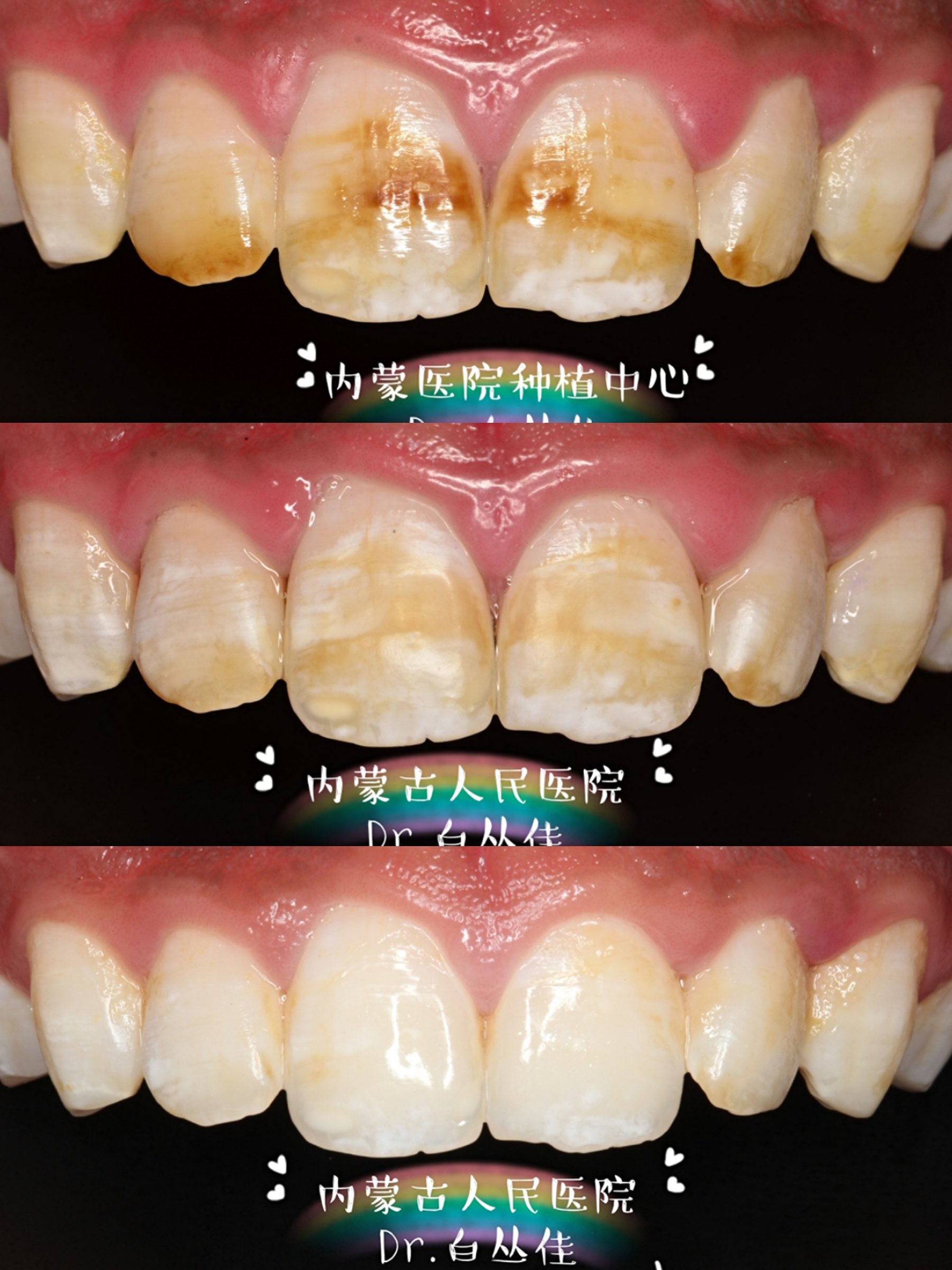 氟斑牙患者通过牙齿漂白也可以达到相对令人满意的效果,一个疗程大约