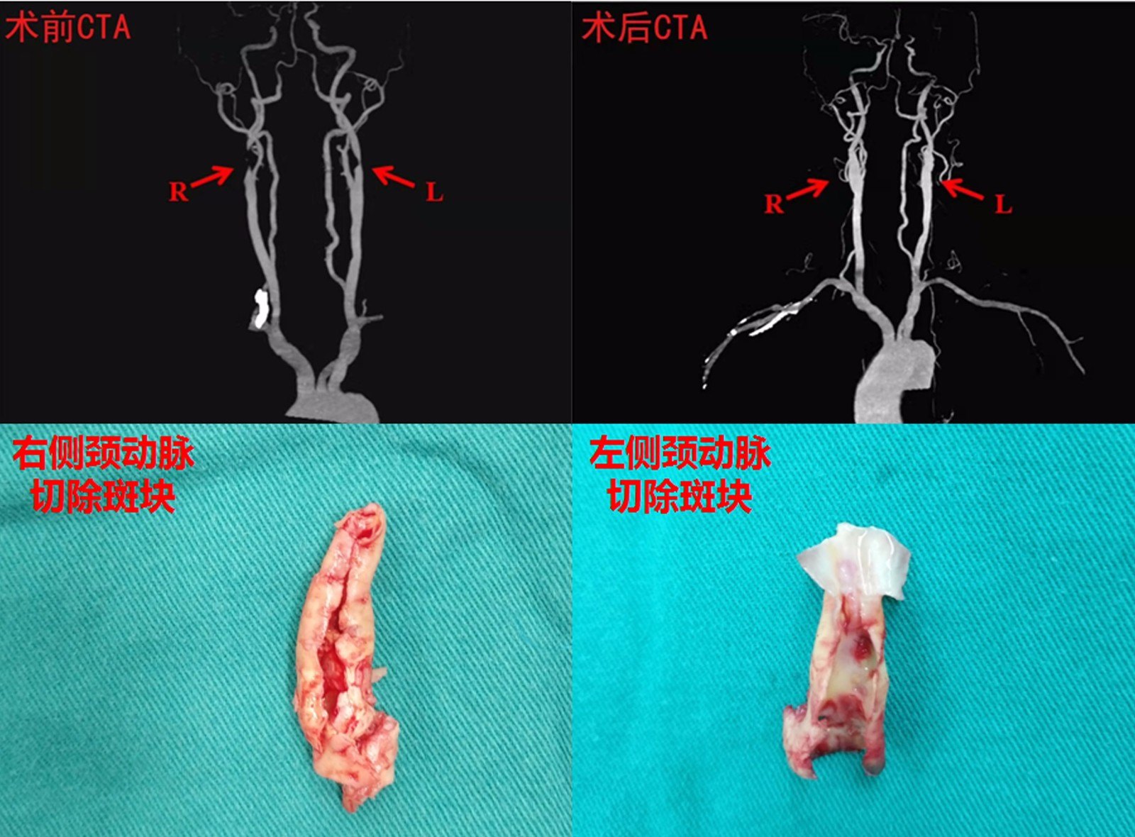 頸動脈狹窄,藥物治療?支架植入?斑塊切除?