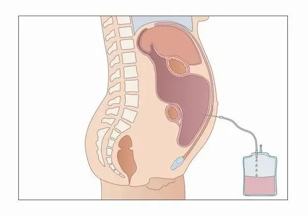 肿瘤腹水处理 肝腹水 肝腹水治疗方式 好大夫在线