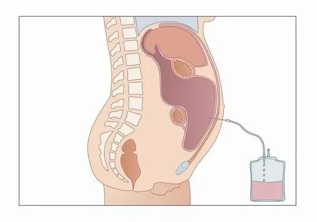 肿瘤腹水处理 肝腹水 肝腹水治疗方式 好大夫在线 肿瘤腹水处理 肝腹水 肝腹水治疗方式 好大夫在线