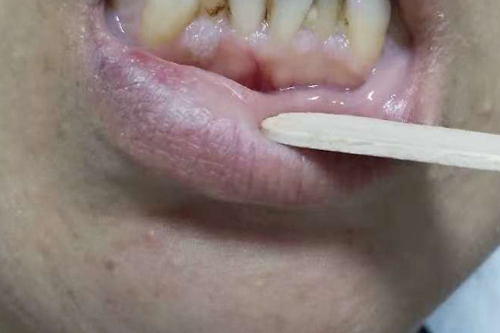 泰安肿瘤医院放四科诊治一例罕见cowden综合征相关乳腺癌