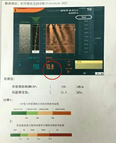 肝纤维化程度按弹性数值分f0,f1,f2,f3和f4五个等级:f0为无肝纤维化