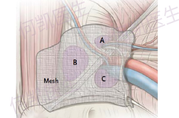 有:1)縫合修補對於一些嵌頓疝患者及對使用修補材料(補片)有顧慮的