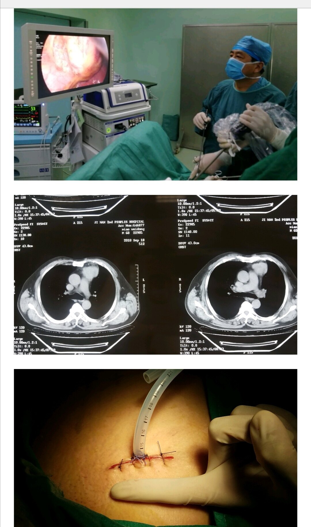 输卵管造影大概费用多少钱_输卵管造影需要自费吗_输卵管造影检查费用能报销吗