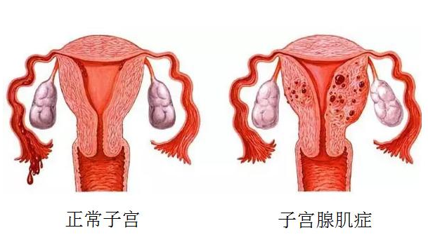 其实无论患有腺肌症,肌瘤的子宫有多大,都是可以保留子宫的,也不用