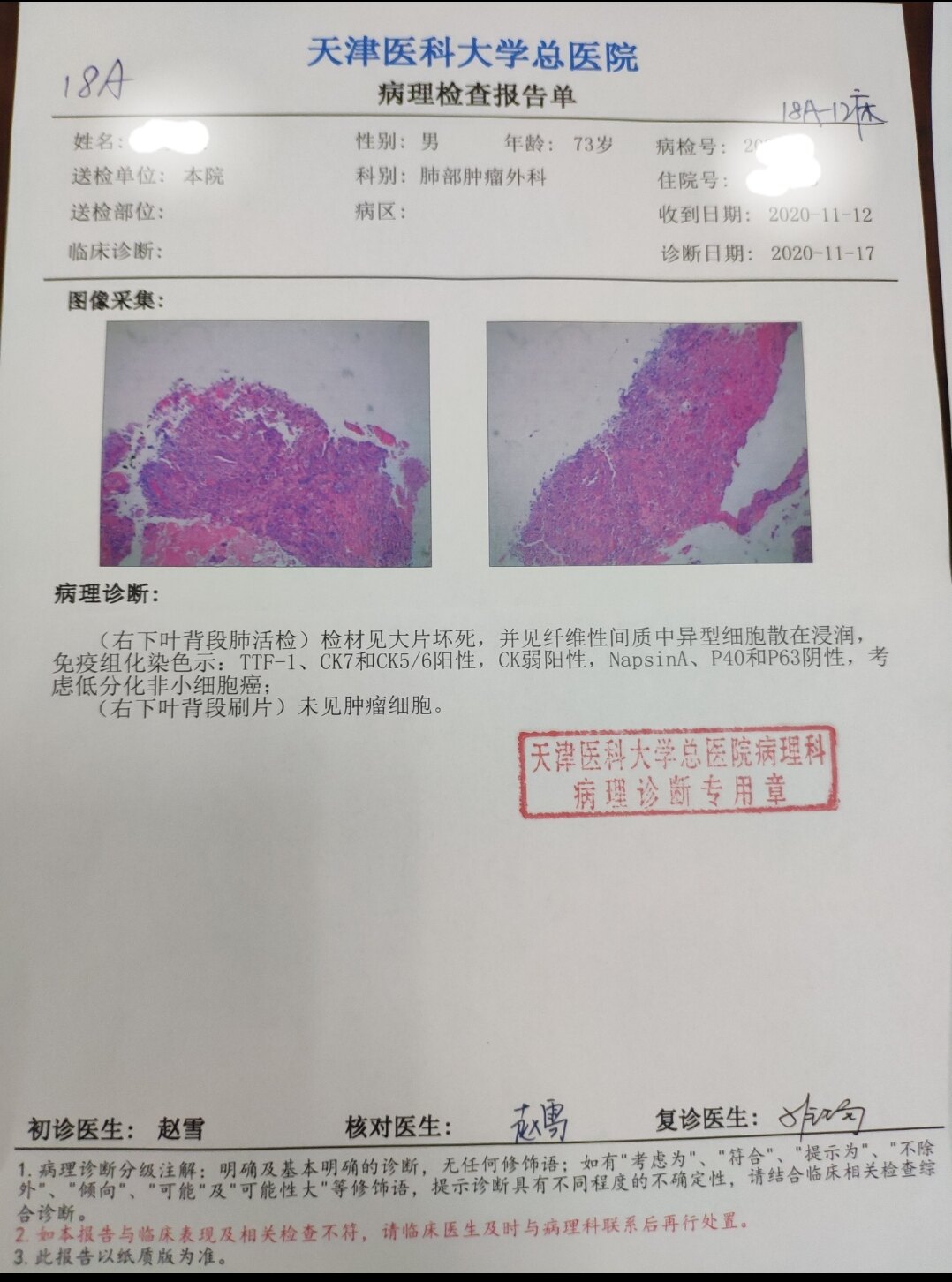 肺癌病理报告 手术图片