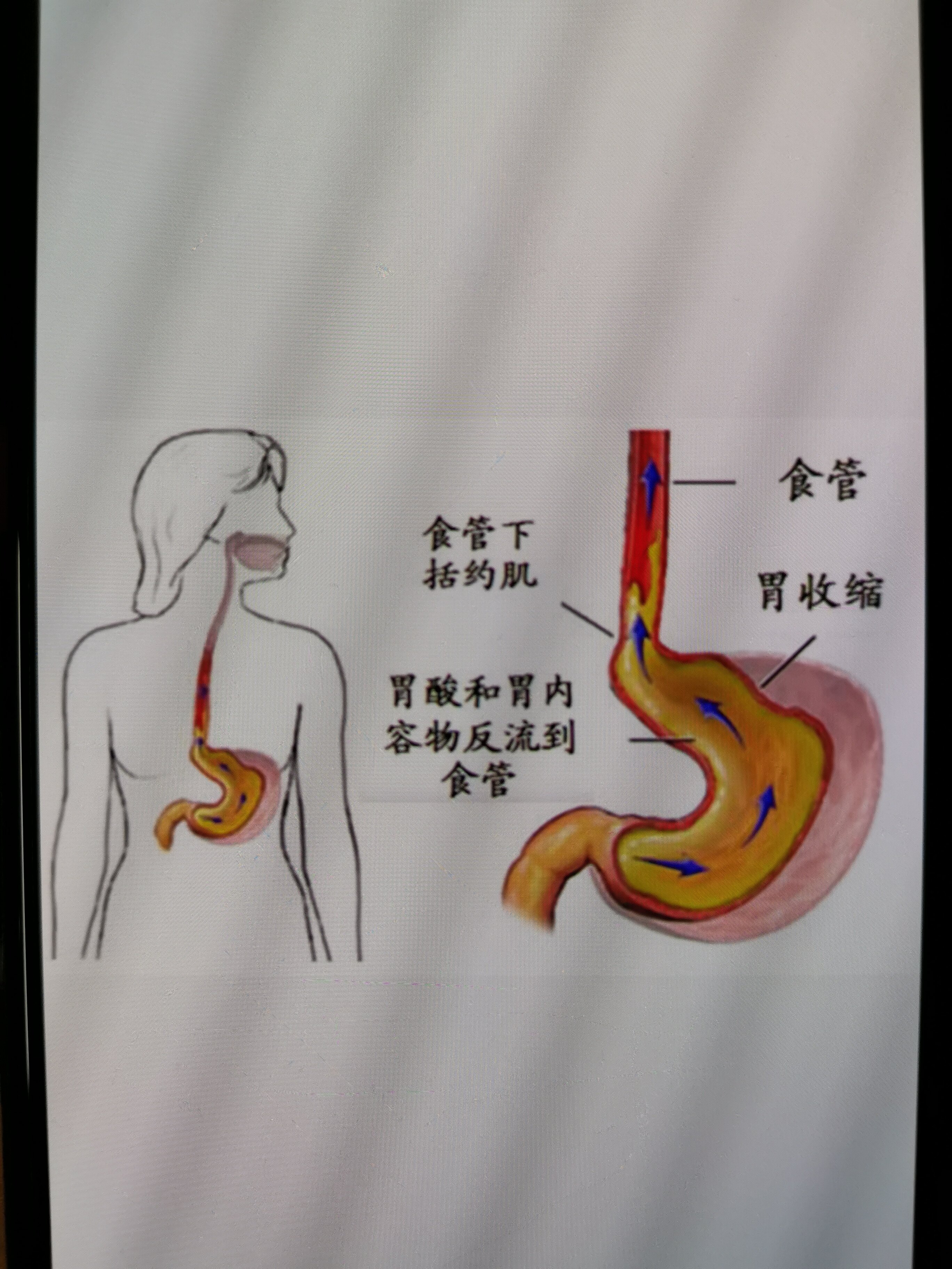 食道炎治疗方法图片