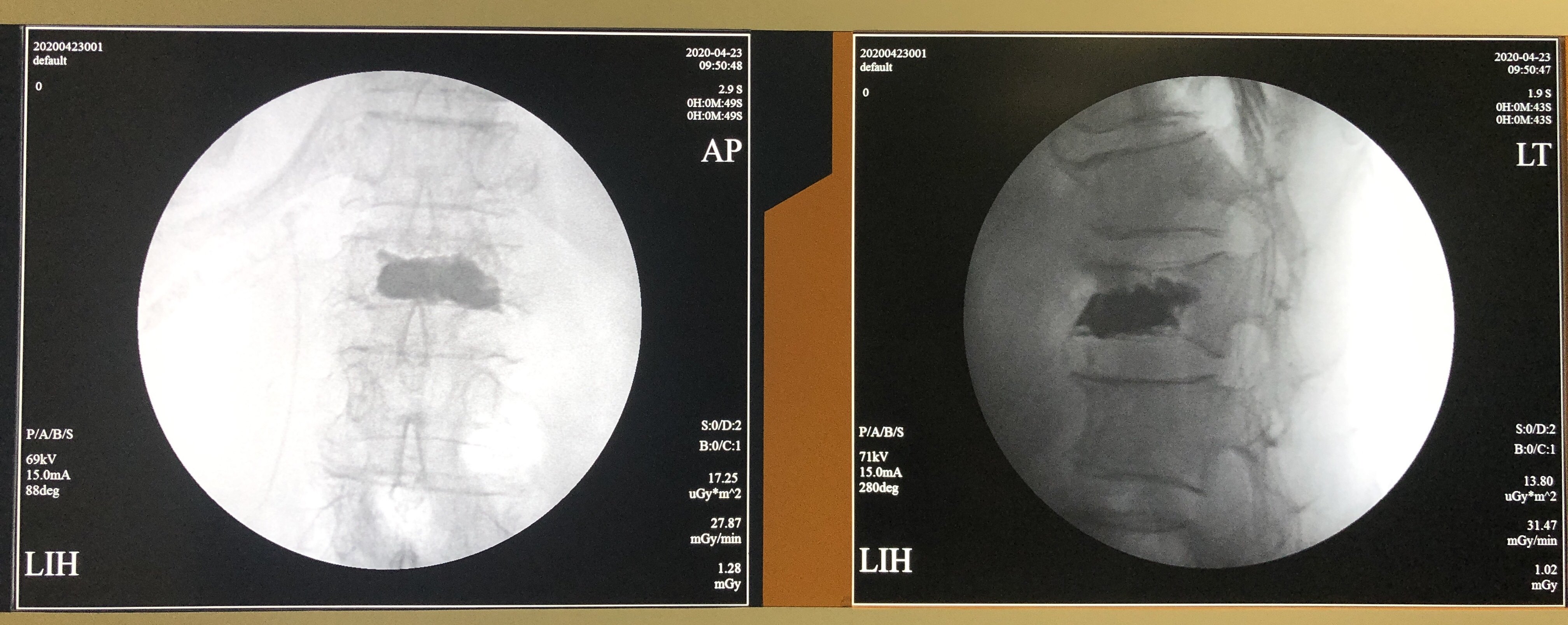 類似球囊擴張後的空腔,硬生生把1w的pvp手術做出了3w的pkp手術的效果!