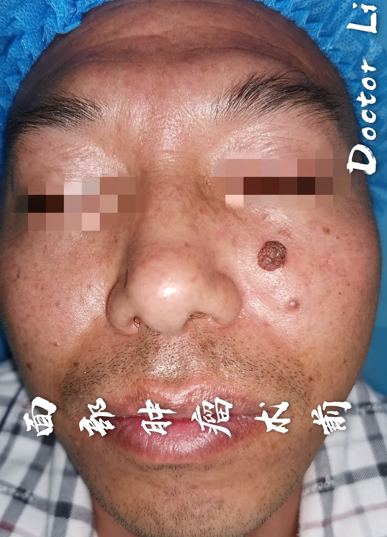 面部黑色素瘤图片大全_面部黑色素瘤能治愈吗_面部黑色素瘤扩散症状