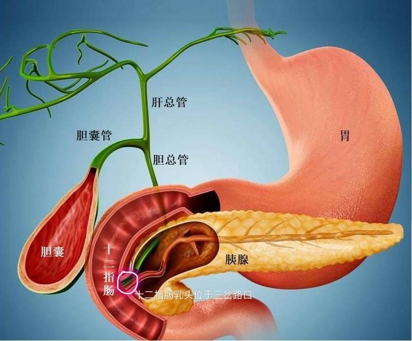 胆管结石容易诱发急性胆源性胰腺炎