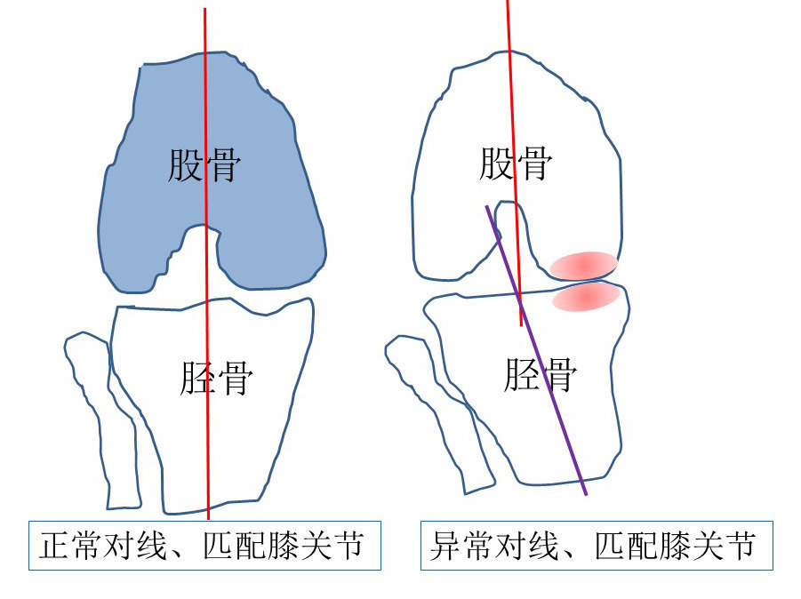 老人骨科系列文章:退行性膝关节骨关节炎(科普)