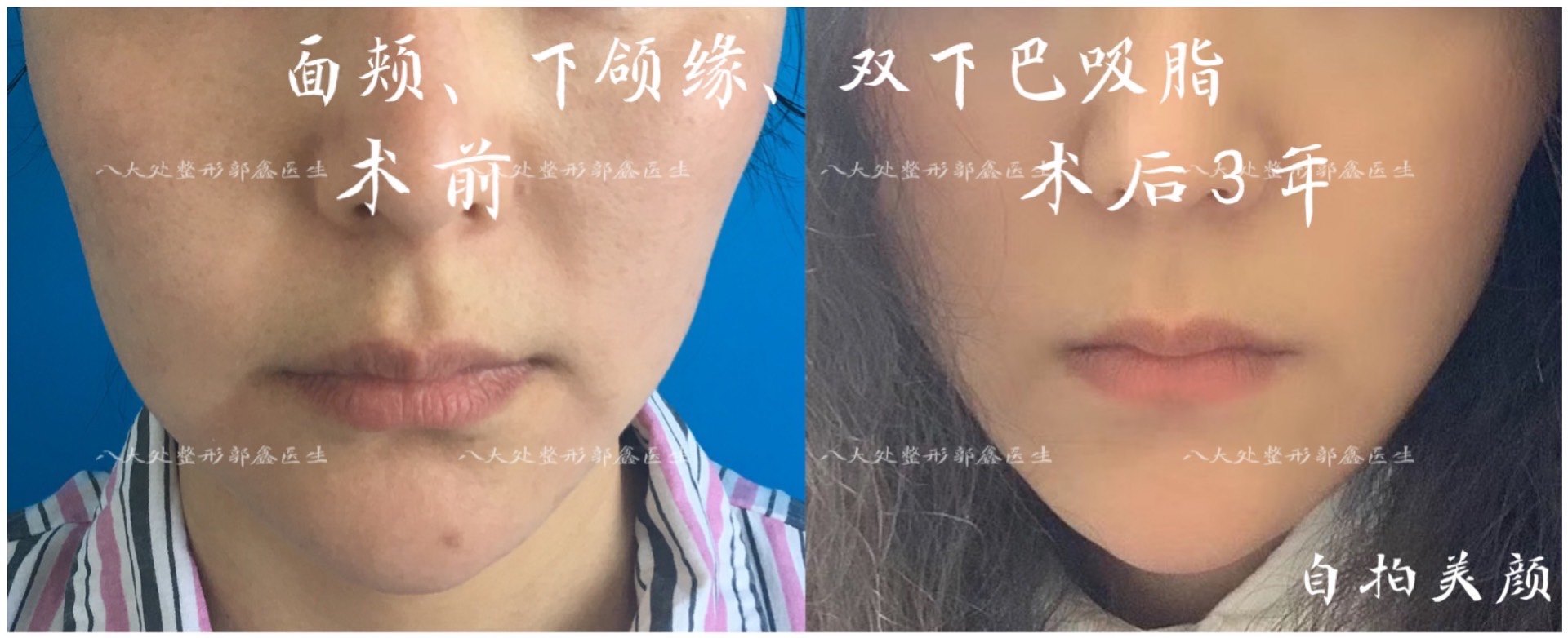面部 双下巴 下颌缘吸脂案例 自然胖 非修复类 郭鑫医生 面部吸脂 好大夫在线 面部 双下巴 下颌缘吸脂案例 自然胖 非修复类 郭鑫医生 面部吸脂 好大夫在线