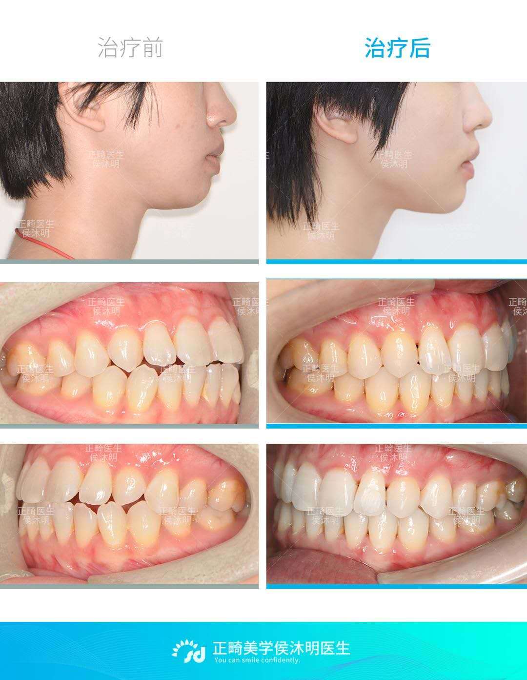 隐适美非拔牙矫正牙性前突案例分享_牙颌畸形_牙颌畸形治疗方式 - 好