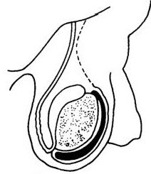 新生儿阴囊积液图片图片