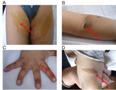 家族性高胆固醇血症黄色瘤_皮肤黄色瘤病_皮肤黄色瘤病介绍 - 好大夫