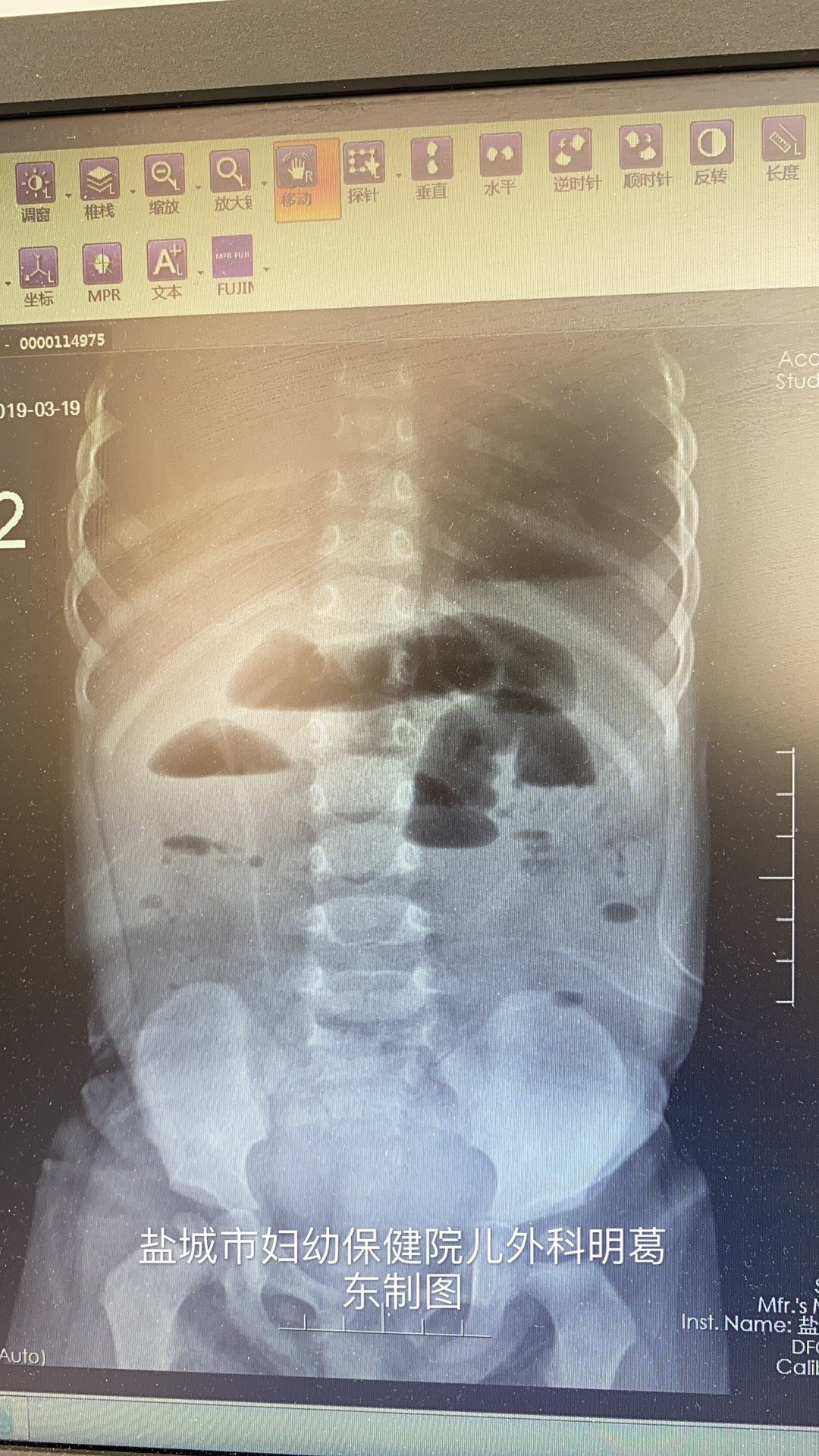 肠梗阻x线表现图片图片