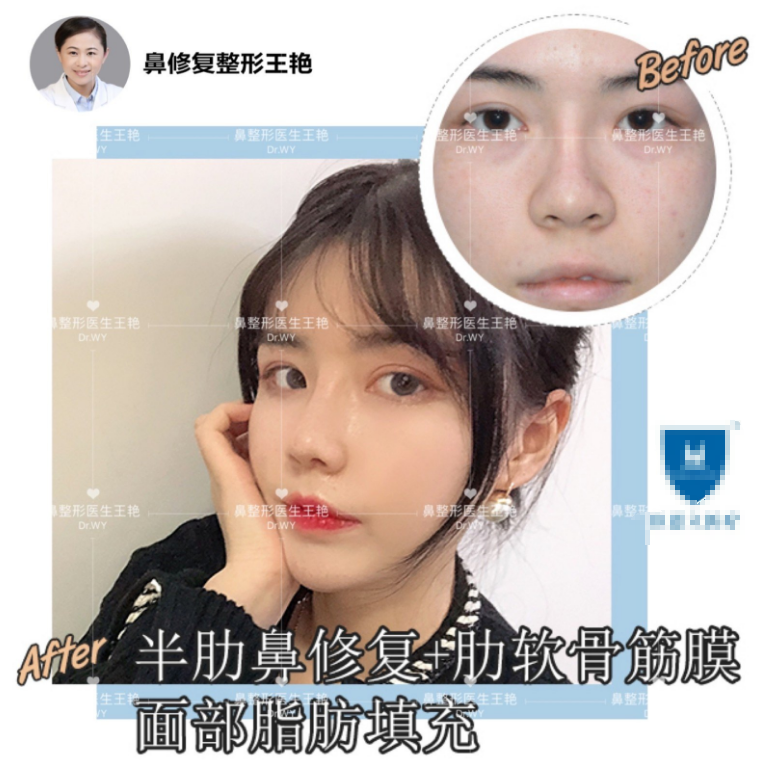 隆鼻失败了 就急着要马上修复 鼻整形修复 鼻整形修复