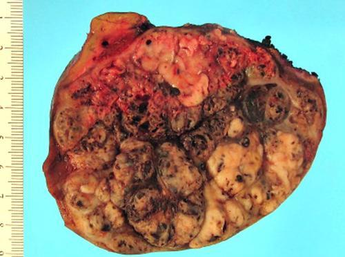 肝母细胞瘤肚子图片