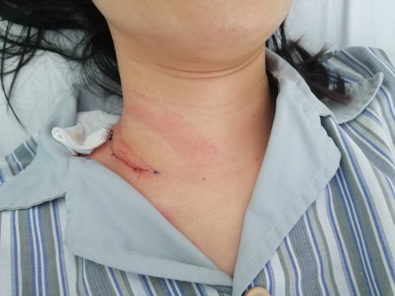 上海六院甲状腺外科,在规范手术和严控并发症(后遗症)的基础上,一直