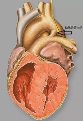 先天性心脏病系列之:先心病是怎么发生的?
