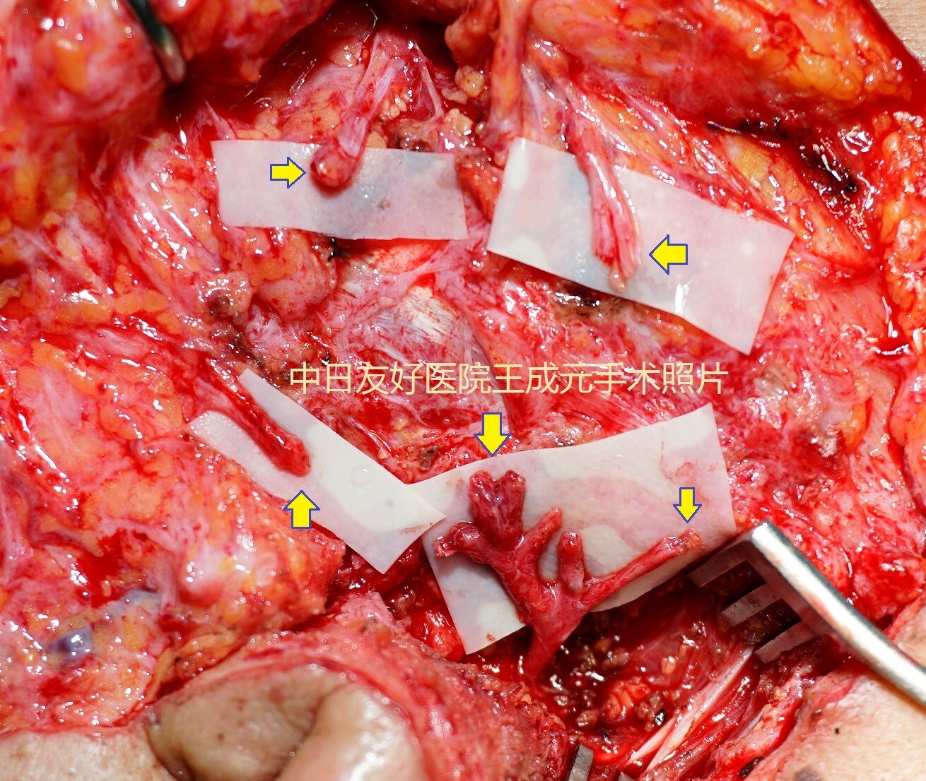 腮腺瘤手術後面癱怎麼辦面神經移植怎麼做