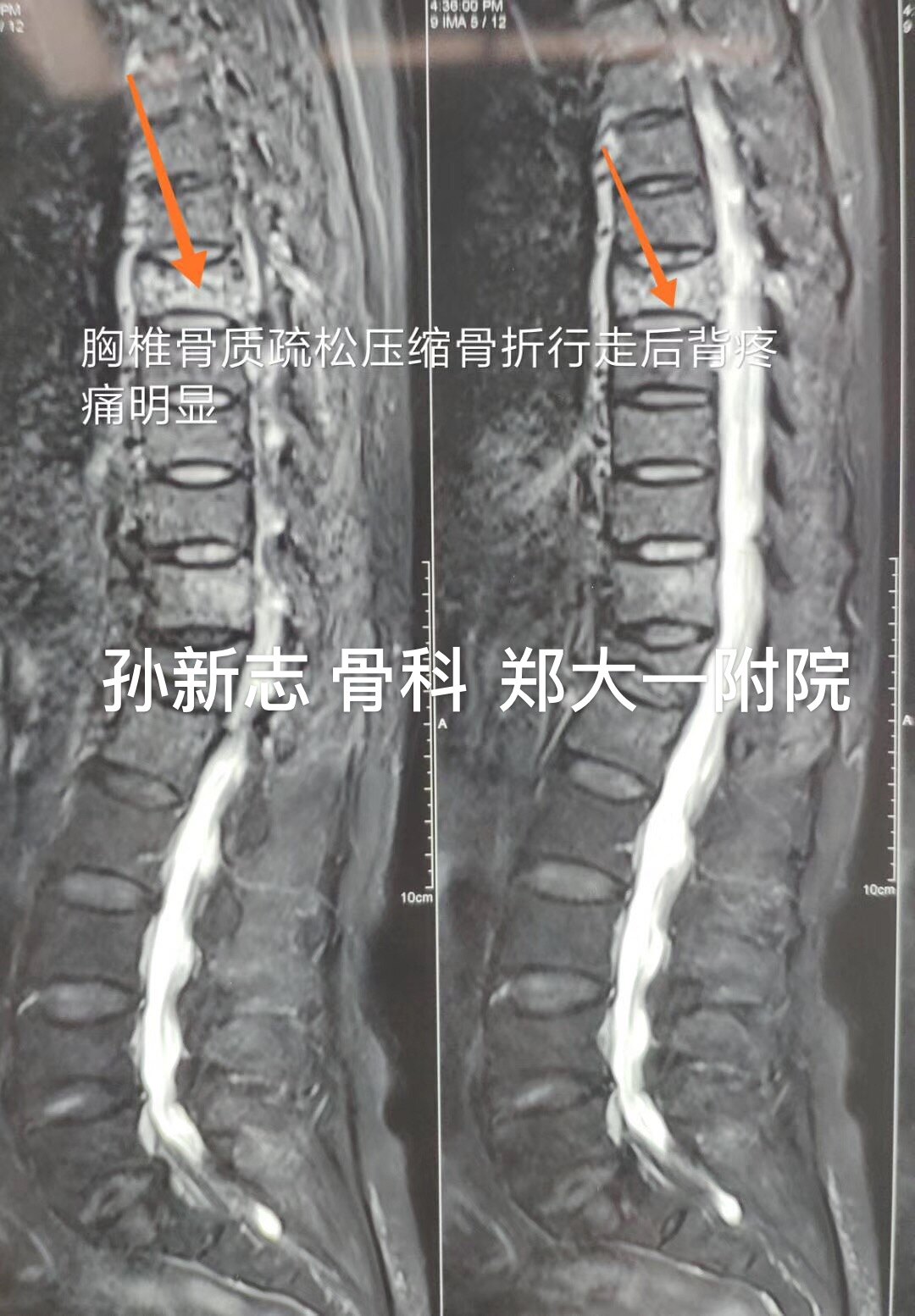 骨水泥手術 脊椎壓迫性骨折 陳奕霖醫師 永和耕莘醫院骨科醫師 永和骨科推薦