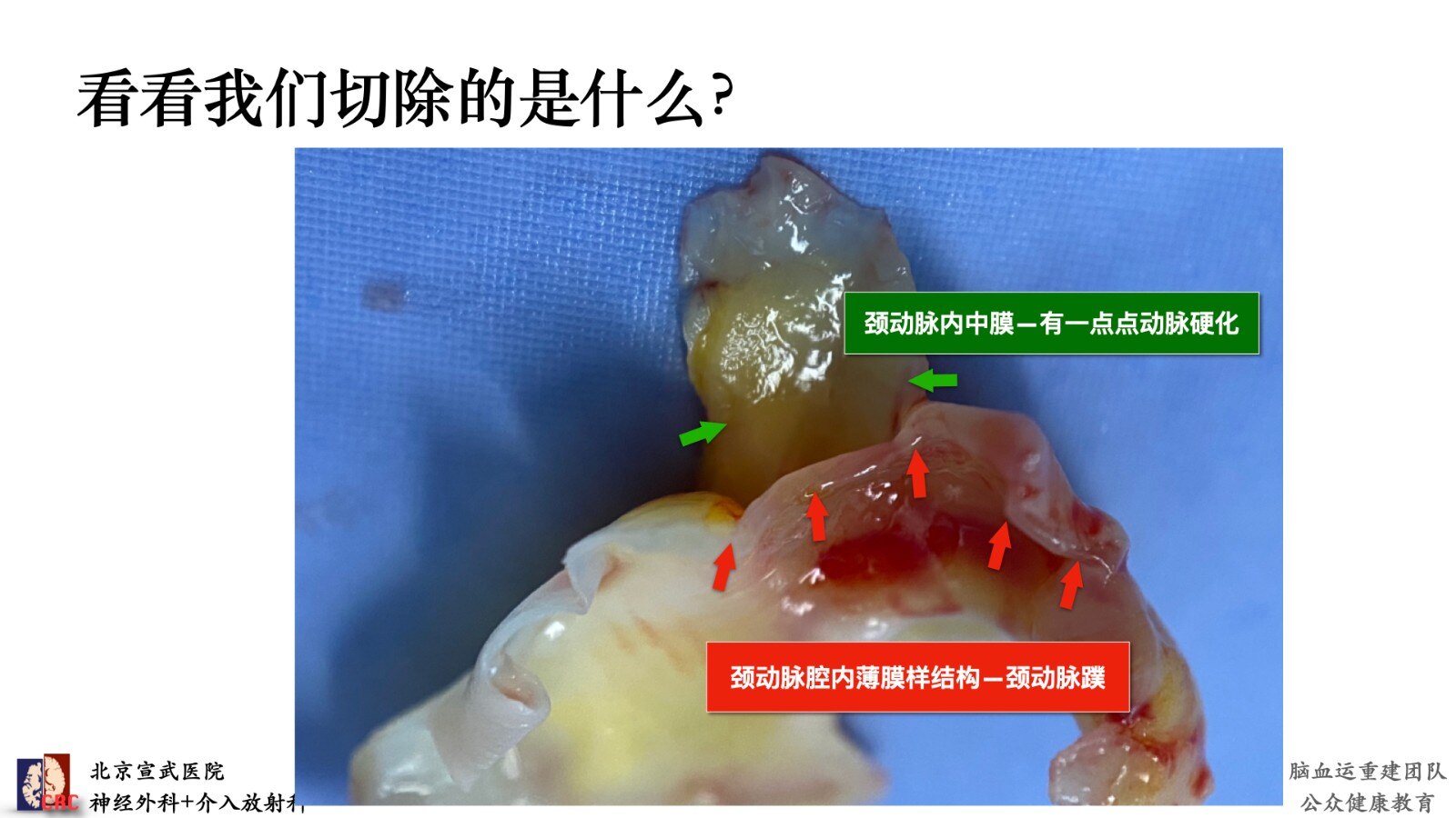颈动脉蹼教您自己看懂这个病