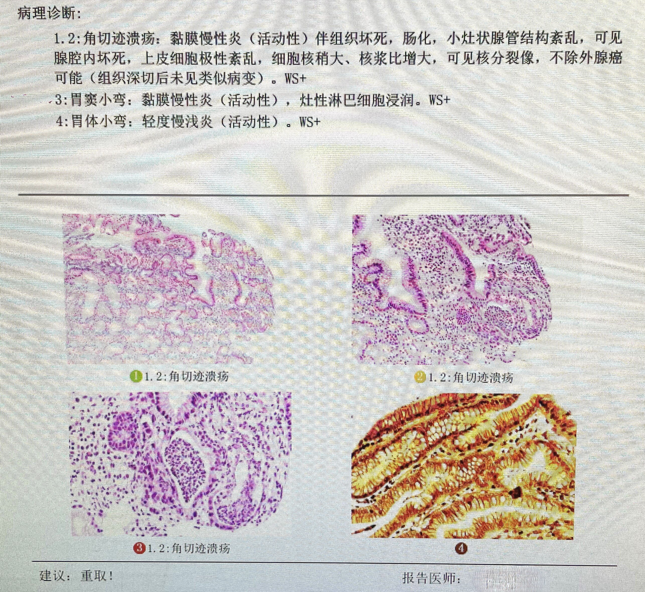 堵德水胃镜2病理.jpg