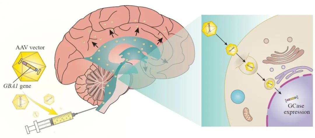 Transl Neurodegener 综述︱中南大学郭纪锋团队评述GBA1基因在帕金森病临床、机制_帕金森_帕金森学术/新进展 - 好大夫在线