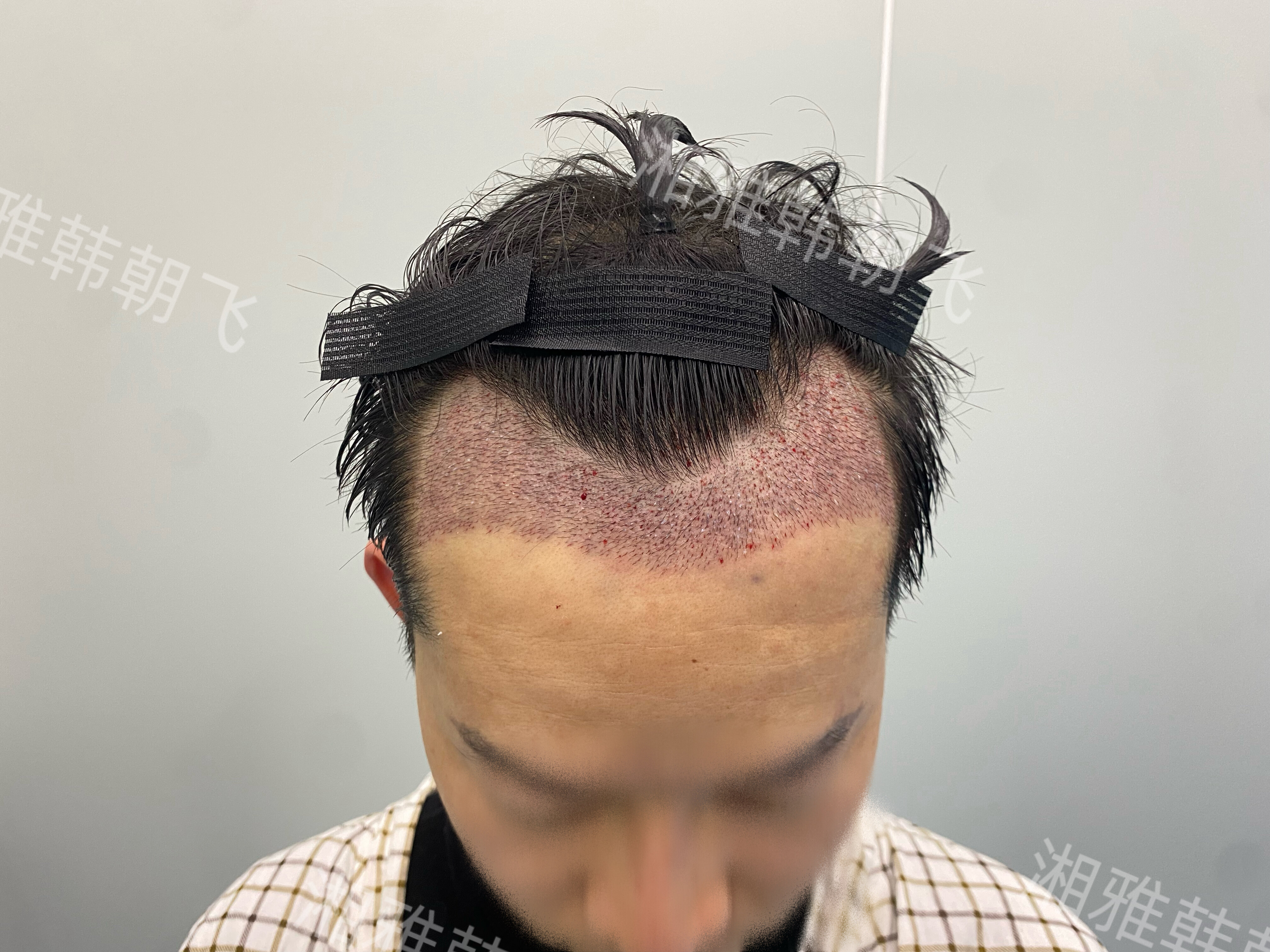 男性发际线植发