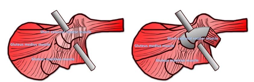1587915212710899.jpg 沿肌纤维走行切开臀大肌,切断短外旋转肌.jpg