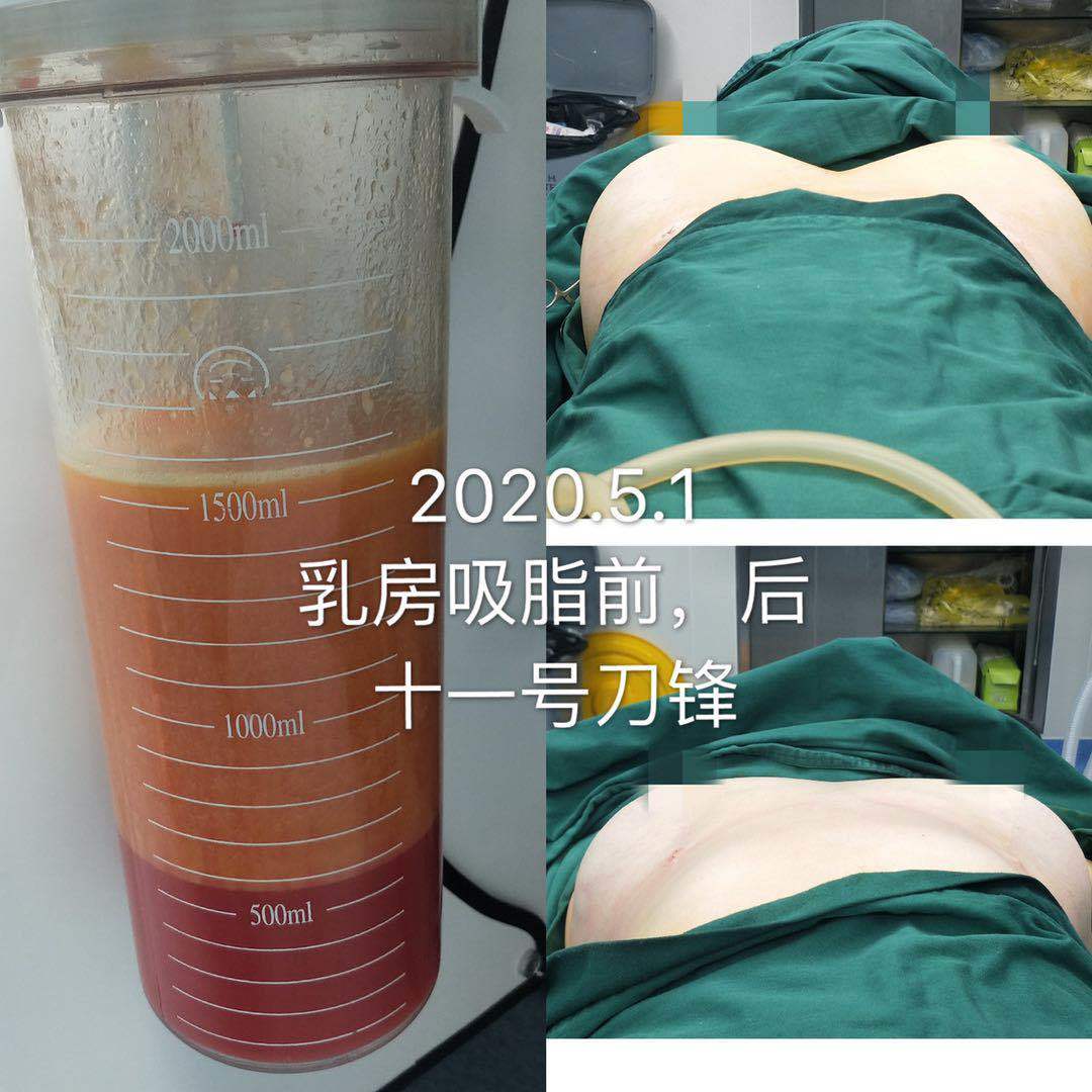 临床经验证实,对于经过合理选择的病例,该术可以使乳房容积减少20%