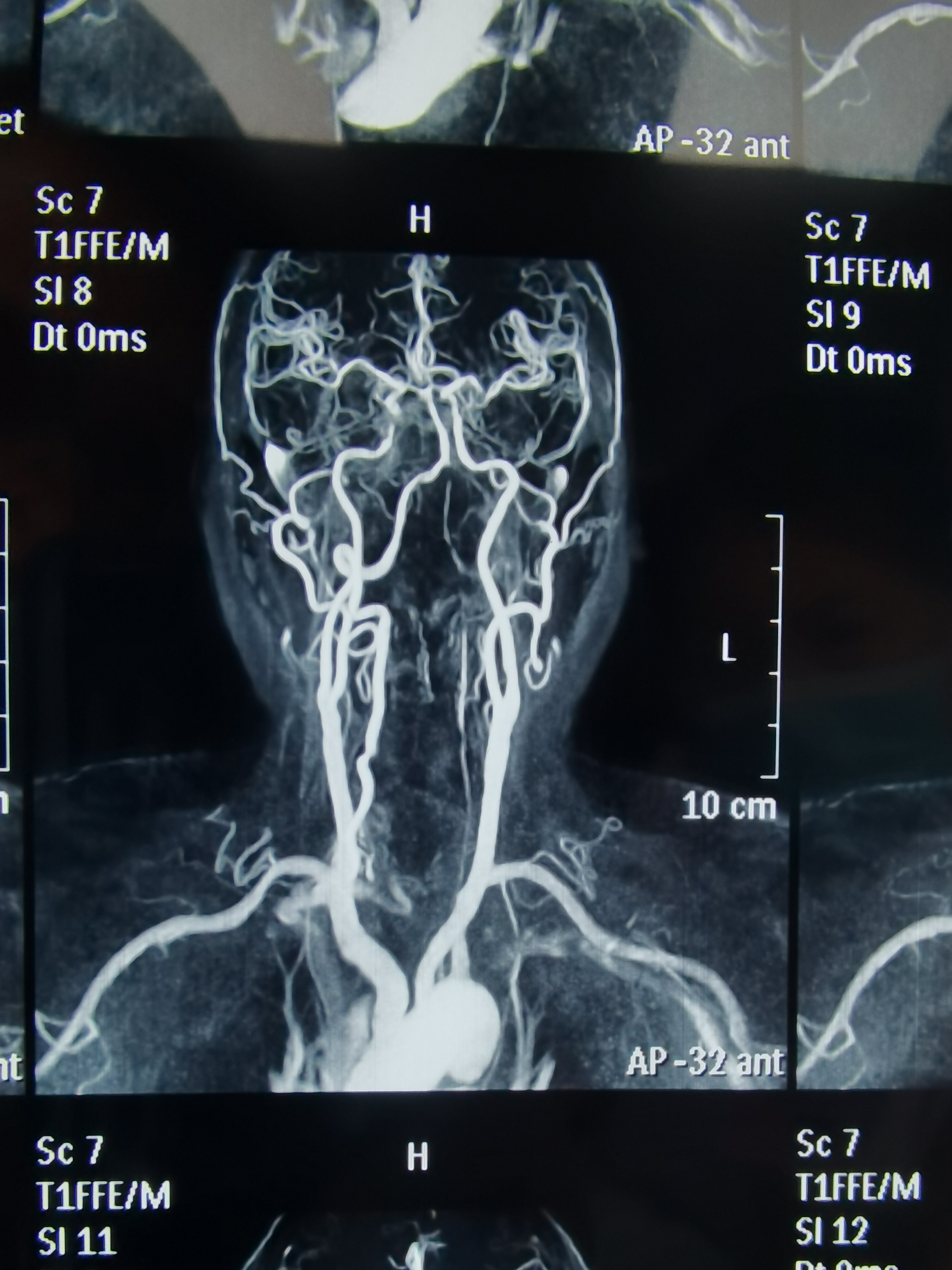 左侧椎动脉位置图片图片