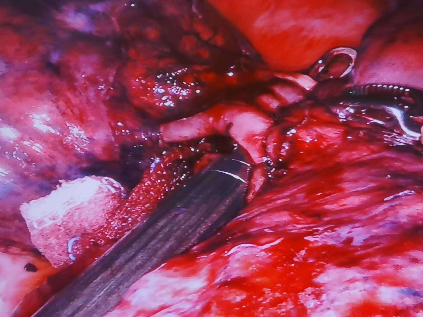 哈医大二院今日完成一例机器人辅助下大咯血症状患者左肺下叶切除术